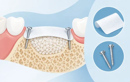 Guided Bone Regeneration: Membranes and Pins