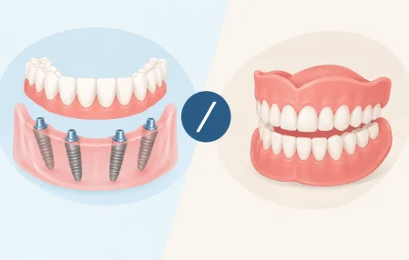 All-on-Four Versus Dentures for Missing Teeth